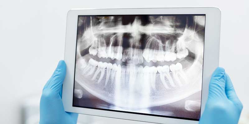 Tampilan Pencitraan Intraoral Gigi